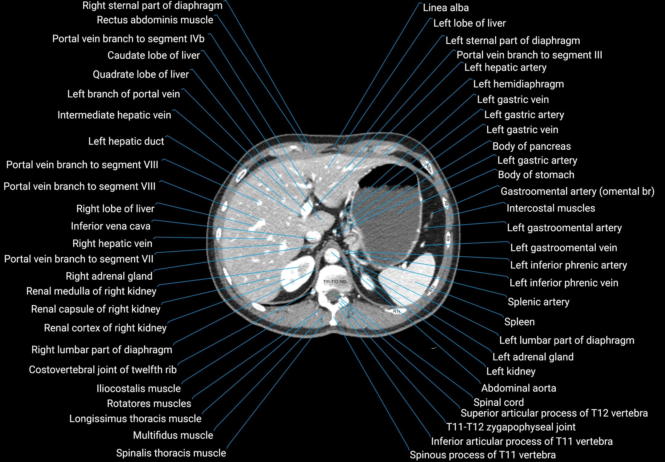 CT male pelvis axial cross sectional anatomy labelled radiology image -00036.webp